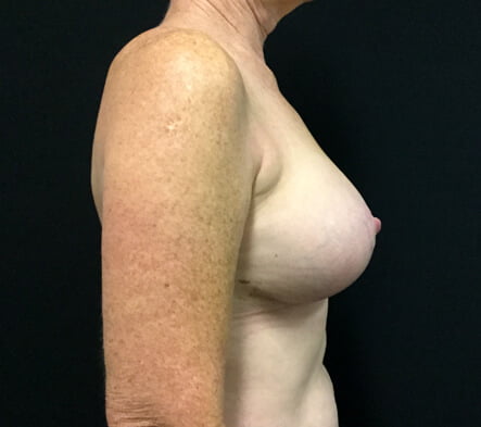 breast implant removal and replacement with mastopexy lift 10