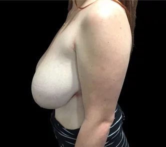 Reduction Mammaplasty - Breast Reduction Surgeon in Brisbane - 3