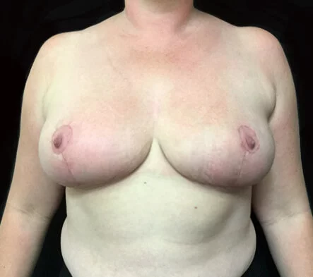 Reduction Mammaplasty - Breast Reduction Surgeon in Brisbane - 9