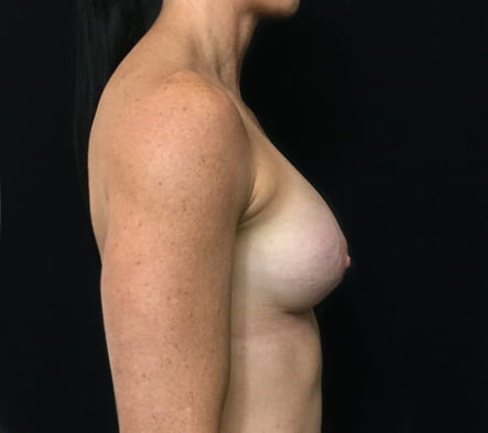 augmentation after breastfeeding Brisbane and Ipswich surgeon