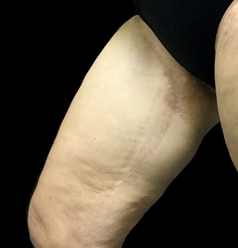 thigh reduction scars