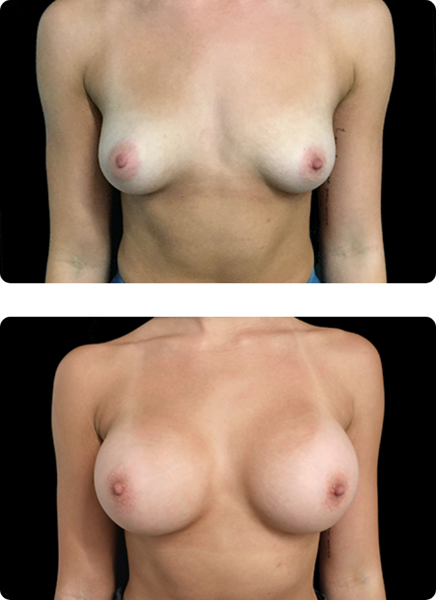 Breast surgeon which implants Brisbane