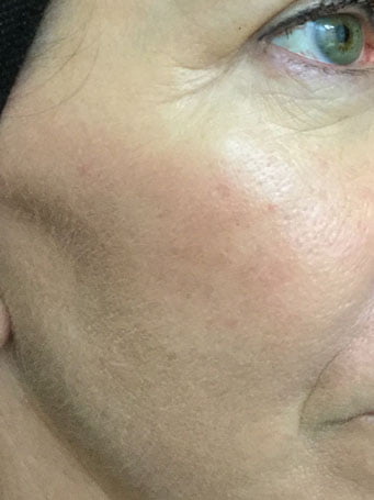 Fraxel for removal of pigmentation
