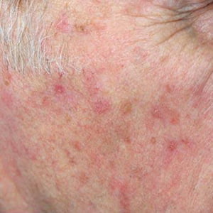 Brisbane skin cancer treatment