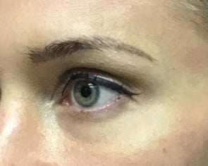 Botox brow lift Brisbane before and after