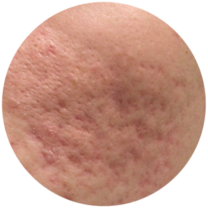 treatment for acne pigmentation and scarring