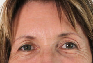 Botox for crows feet South Brisbane East Brisbane and Ipswich