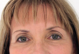 Botox for crows feet wrinkles South Brisbane East Brisbane and Ipswich