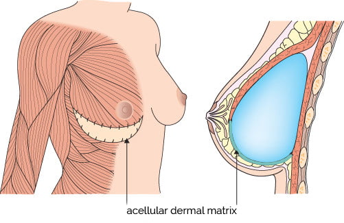 dermal matrix ADM breast implants