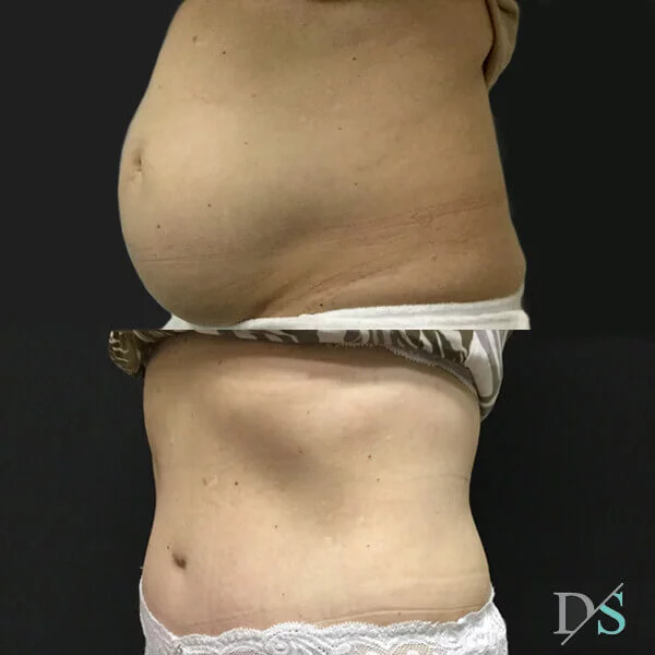 Postpartum abdominoplasty with abdominal wall reconstruction - 1