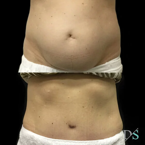 Postpartum abdominoplasty with abdominal wall reconstruction - 2