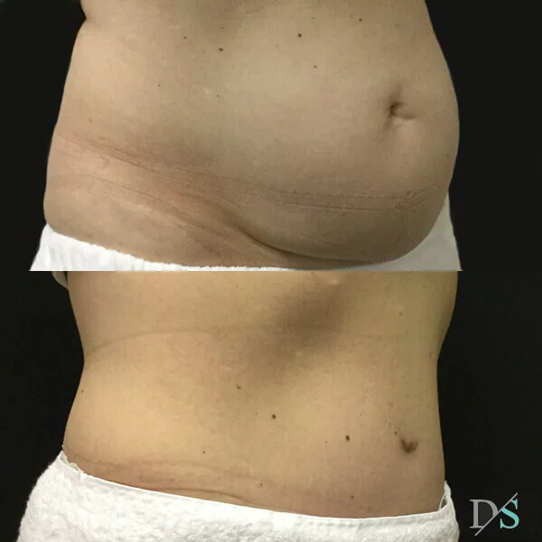 Postpartum abdominoplasty with abdominal wall reconstruction - 3