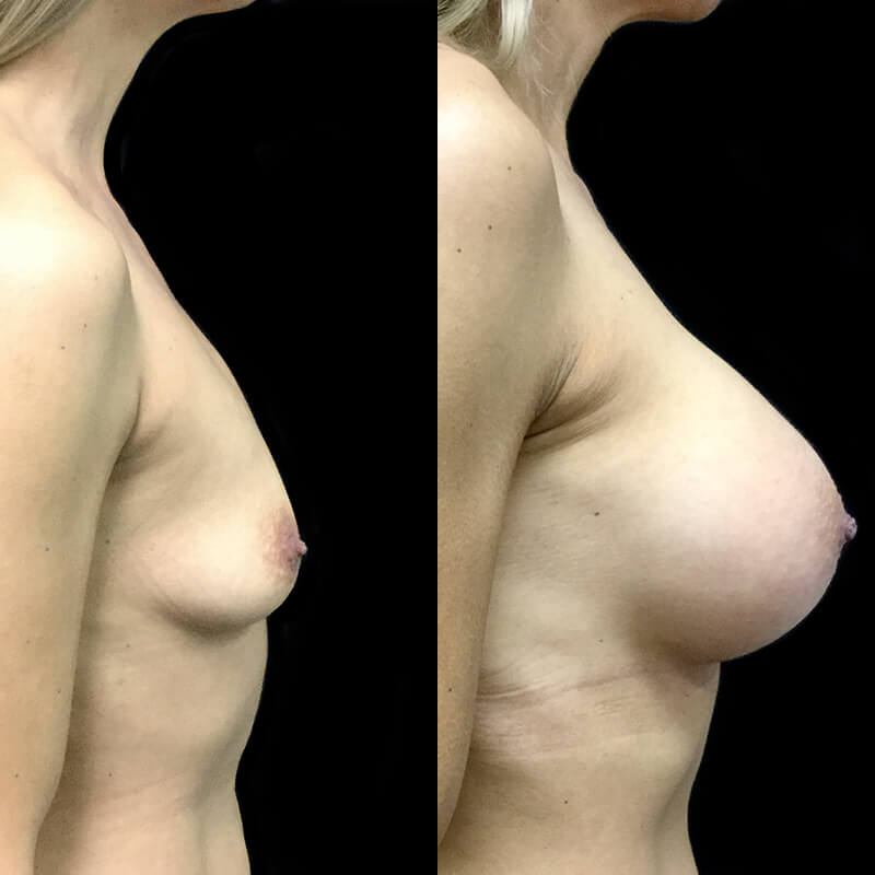 Best breast augmentation surgeons Dr David Sharp 
