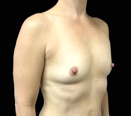 breast augmentation surgeon Brisbane south east