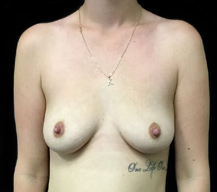 Breast augmentation plastic cosmetic surgeon
