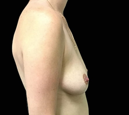 breast augmentation Brisbane surgeon