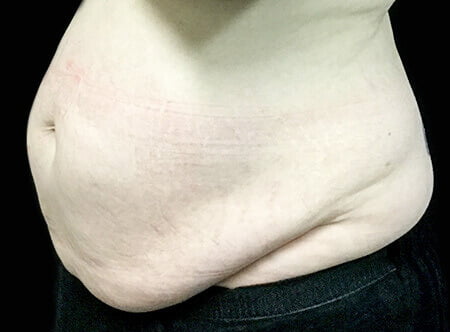 abdominoplasty liposuction Dr Sharp