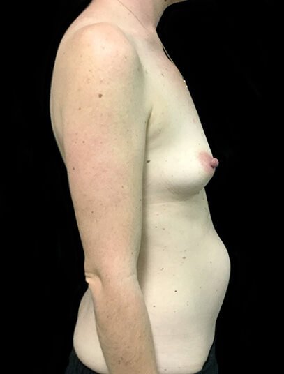 Breast augmentation abdominoplasty Brisbane and Ipswich