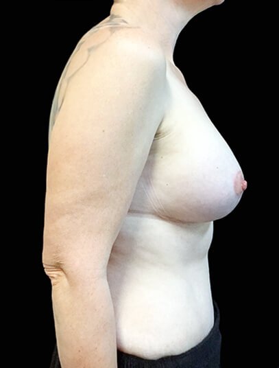 breast augmentation lift and abdominoplasty Brisbane which surgeon Dr Sharp