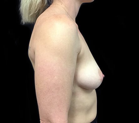 Recommended Brisbane and Ipswich plastic surgeons for breast lift