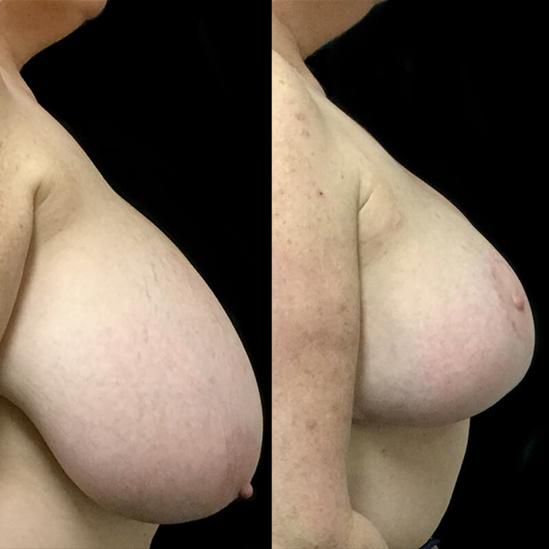 South East Brisbane breast reduction