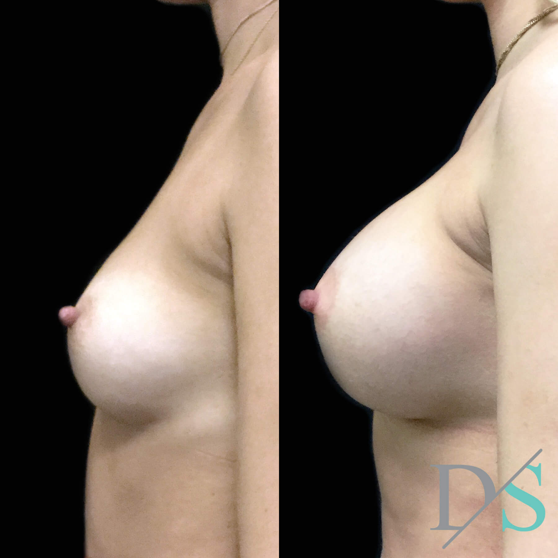 Dr David Sharp breast augmentation surgeon Brisbane and Ipswich 