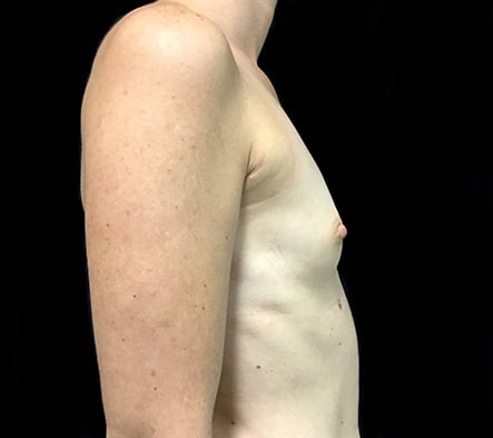 Breast augmentation surgeon Brisbane