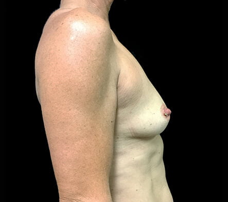 before breast augmentation surgery photos