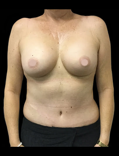 breast augmentation and abdominoplasty Dr David Sharp