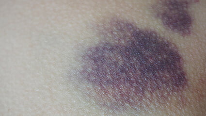 how to reduce bruising after surgery or injectables