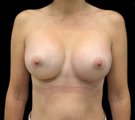 Breast augmentation photos Brisbane and Ipswich