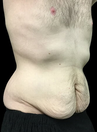 abdominoplasty after weightloss