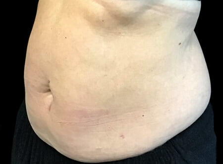 abdominoplasty results Dr Sharp