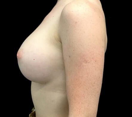 breast augmentation surgeon