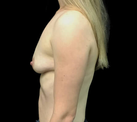 Dr Sharp breast augmentation