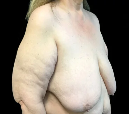 Brisbane breast reduction surgeon