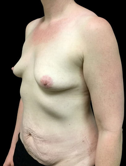 abdominoplasty and breast augmentation 