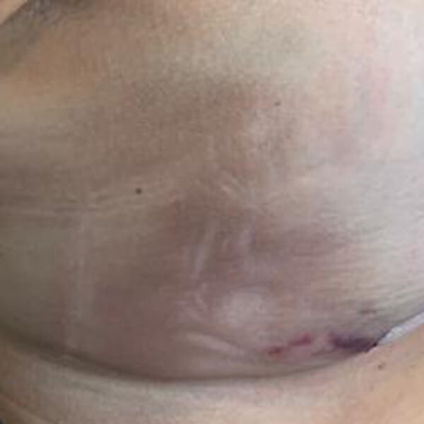 Bruising after breast surgery - 1