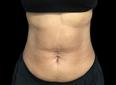 Abdominoplasty before and after Dr Sharp AVai 2