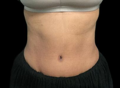 Abdominoplasty before and after Dr Sharp AVai 2b
