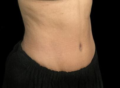 Abdominoplasty before and after Dr Sharp AVai 3b