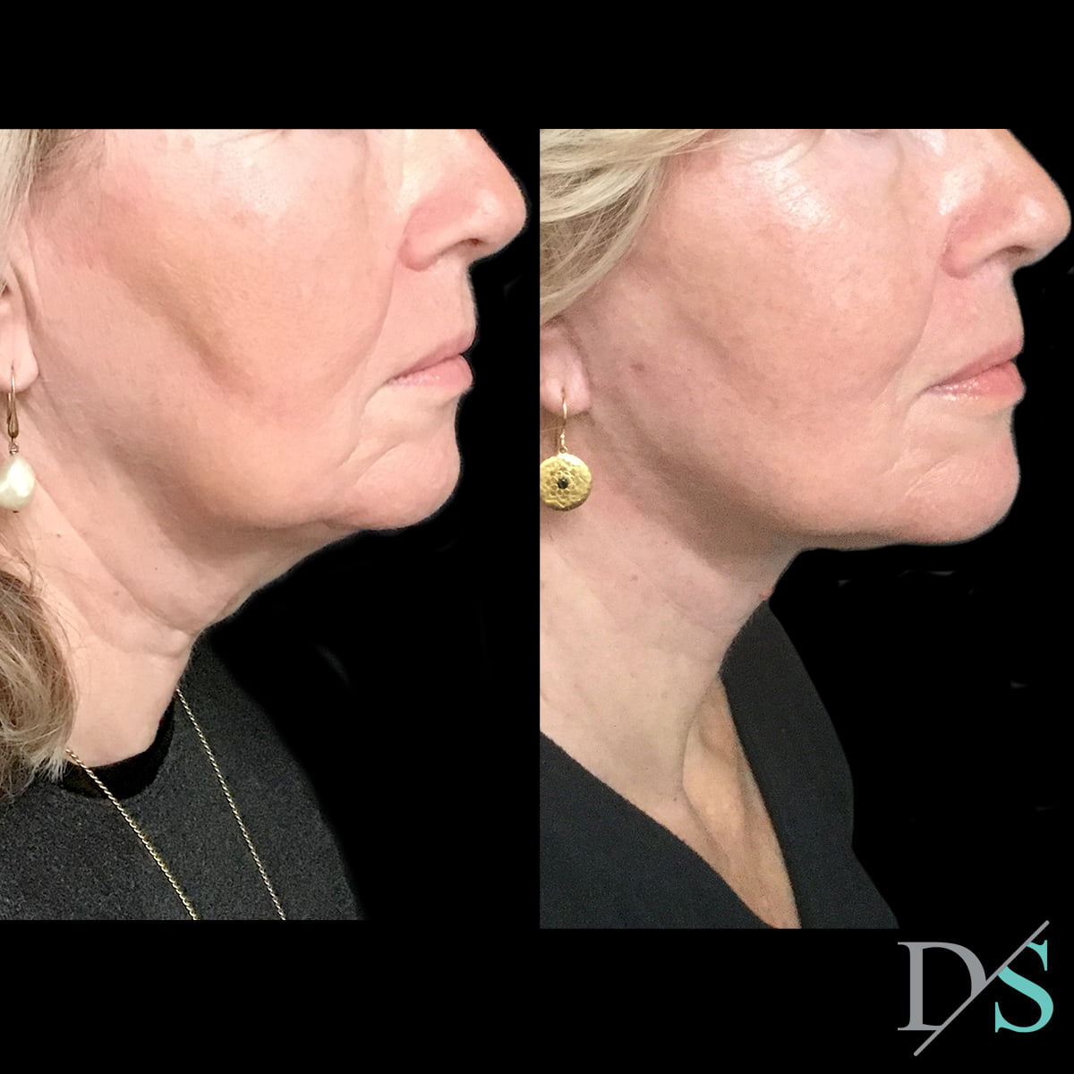 Brisbane surgeon facelift before and after Dr David Sharp