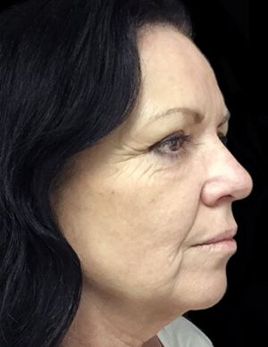 Facelift after photo Dr David Sharp Plastic surgeon before