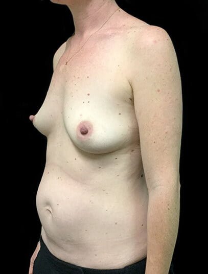 abdominoplasty and breast augmentation plastic surgeon Dr David Sharp Brisbane after