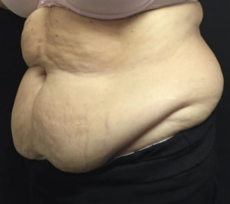 abdominoplasty massive weightloss Brisbane Ipswich 1a