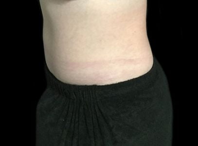 abdominoplasty Brisbane MY before and after 2