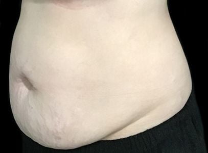 abdominoplasty Brisbane MY before and after 3