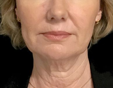 before and after facelift surgery with Dr Sharp plastic surgeon 1