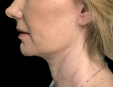 before and after facelift surgery with Dr Sharp plastic surgeon 6