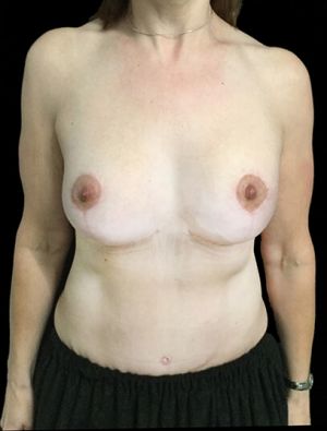 breast lift augmentation and abdominoplasty body lift mummy makeover Dr Sharp 2 JL 2